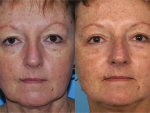 Blepharoplasty (Eyelid Surgery)