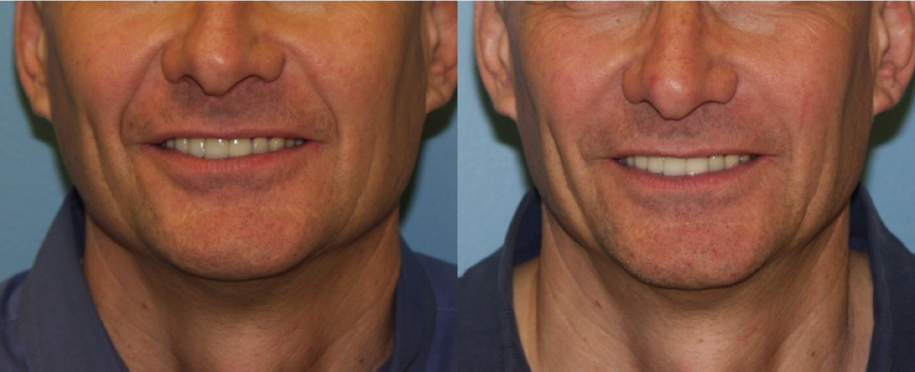 Facial Lines and Wrinkles