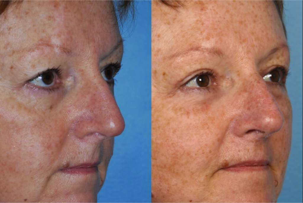 Blepharoplasty (Eyelid Surgery)