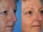 Blepharoplasty (Eyelid Surgery)