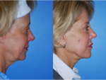 Facelift and Necklift