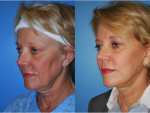 Facelift and Necklift