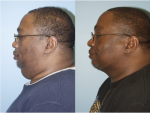 Chin and Submental Liposuction