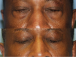 Blepharoplasty (Eyelid Surgery)