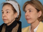 Facelift and Necklift