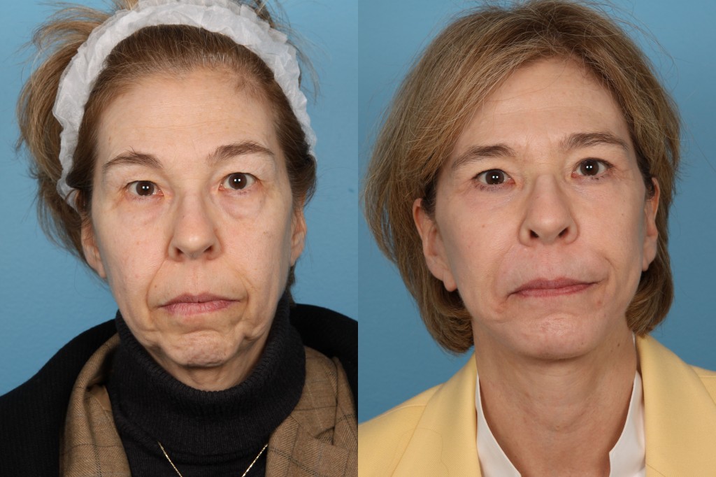 Facelift and Necklift