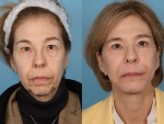 Facelift and Necklift