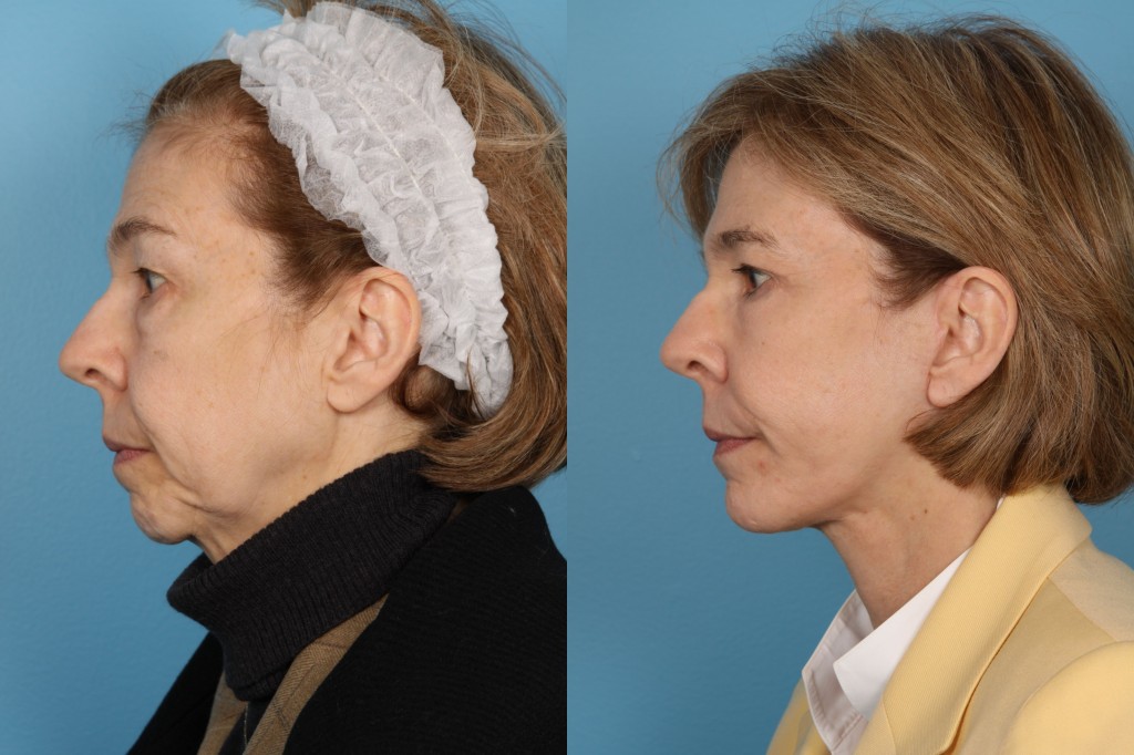 Facelift and Necklift