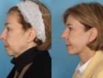 Neck lift Surgery Before & After Photo