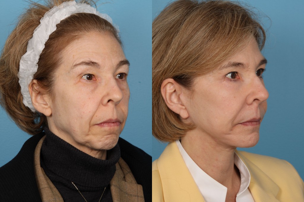 Facelift and Necklift