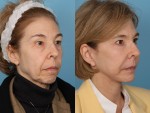 Facelift and Necklift