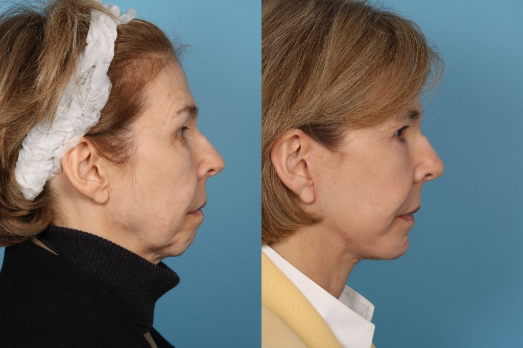 Facelift and Necklift