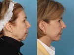 Facelift and Necklift