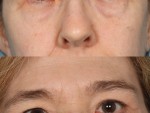 Blepharoplasty (Eyelid Surgery)