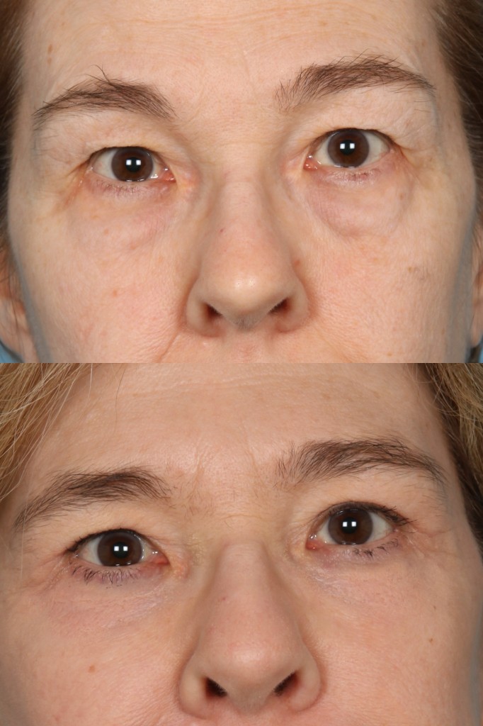 Blepharoplasty (Eyelid Surgery)