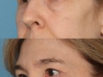 Blepharoplasty (Eyelid Surgery)