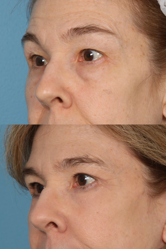 Blepharoplasty (Eyelid Surgery)