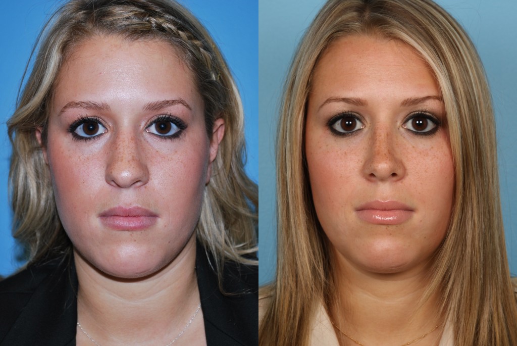 Rhinoplasty (Nose Job)