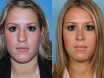 Rhinoplasty (Nose Job)