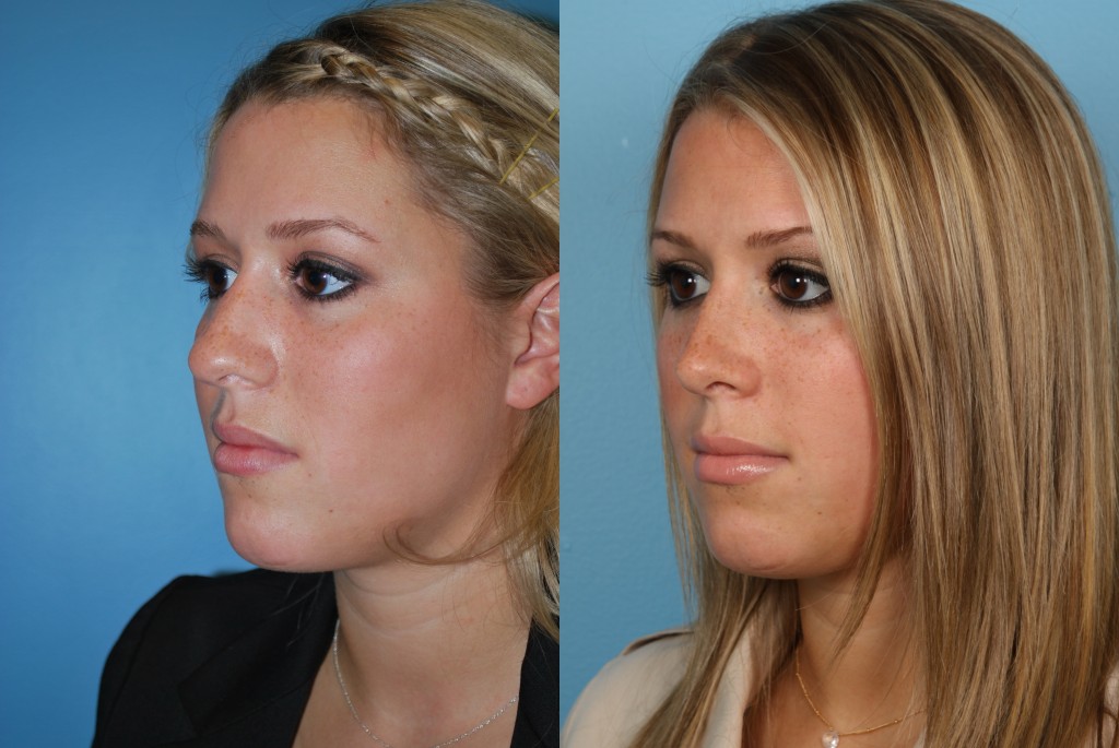 Rhinoplasty (Nose Job)