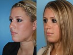 Rhinoplasty (Nose Job)