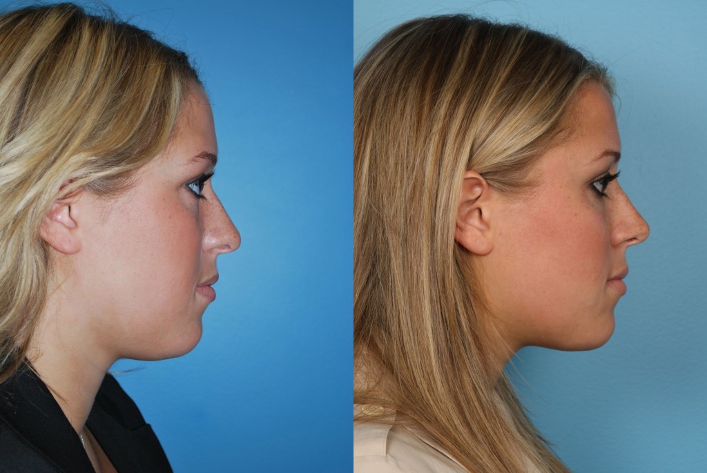 Rhinoplasty (Nose Job)