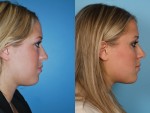 Rhinoplasty (Nose Job)