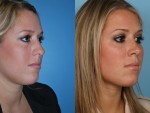 Rhinoplasty (Nose Job)