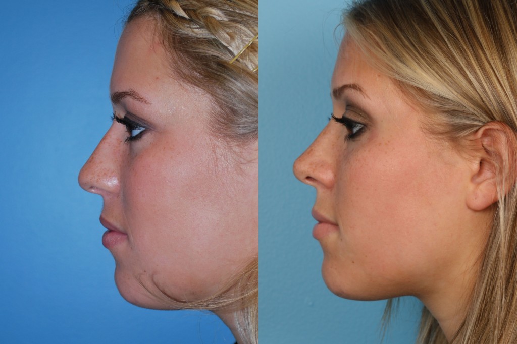 Rhinoplasty (Nose Job)