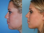 Rhinoplasty (Nose Job)