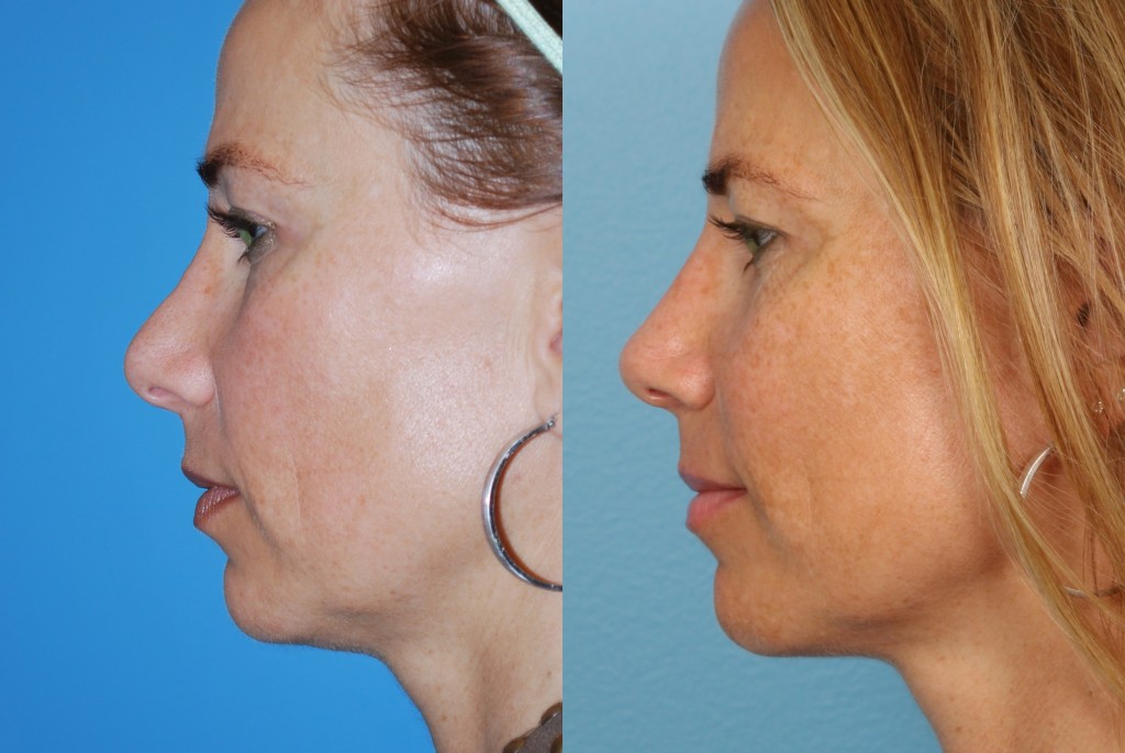 Revisions Rhinoplasty