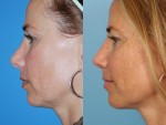 Revision Rhinoplasty