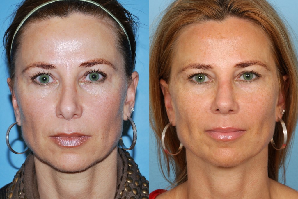 Revisions Rhinoplasty