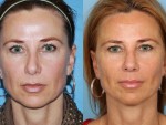 Revision Rhinoplasty