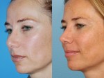 Revision Rhinoplasty