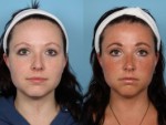 Skin Resurfacing