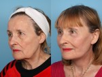 Facelift and Necklift