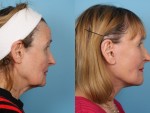 Facelift and Necklift