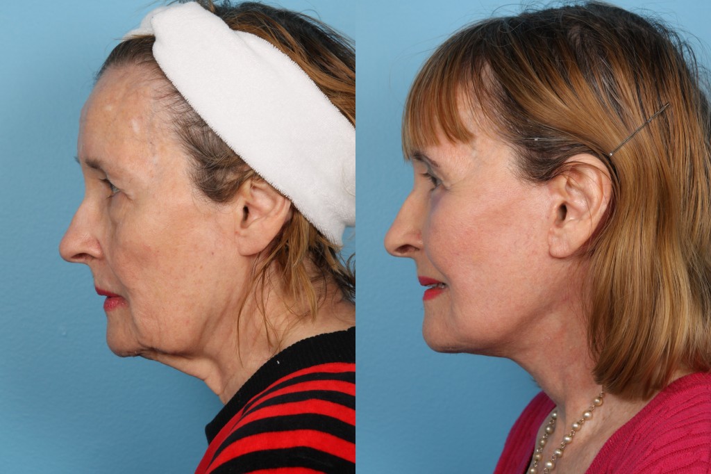 Facelift and Necklift