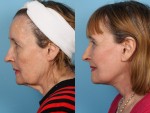 Facelift and Necklift