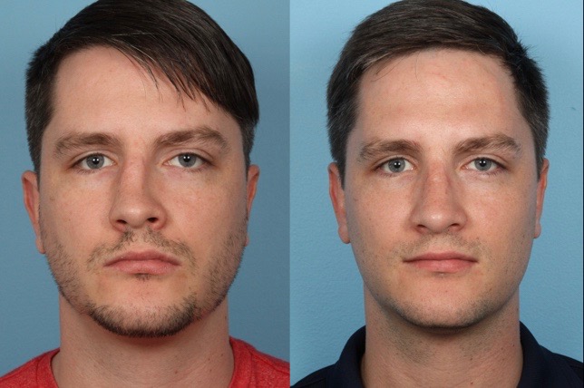 Male Rhinoplasty