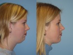 Before & After Pictures | Chin & Submental Liposuction Chicago, IL