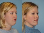 Chin and Submental Liposuction