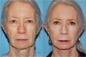 Chemical Peel