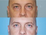 Blepharoplasty (Eyelid Surgery)