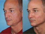 Cheek Augmentation