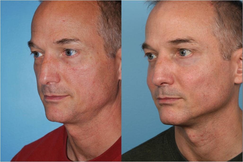 cheekbone implants men before and after