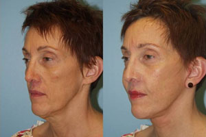 cheek_augmentation