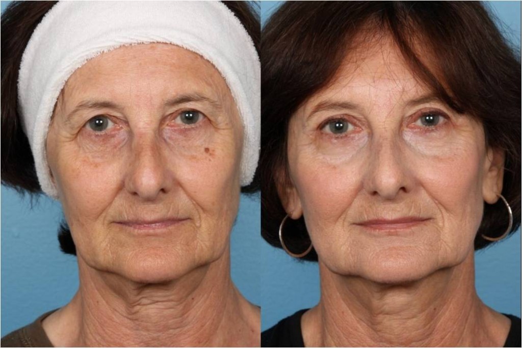 Blepharoplasty (Eyelid Surgery)