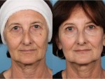 Blepharoplasty (Eyelid Surgery)